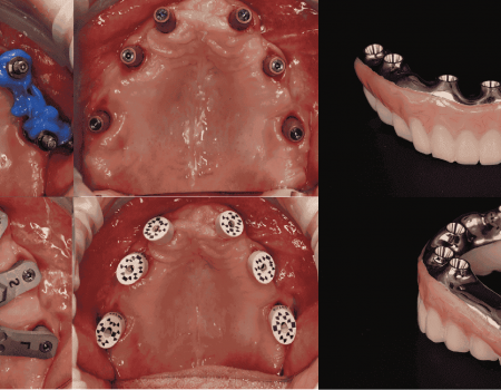 Prothèse Implantaire